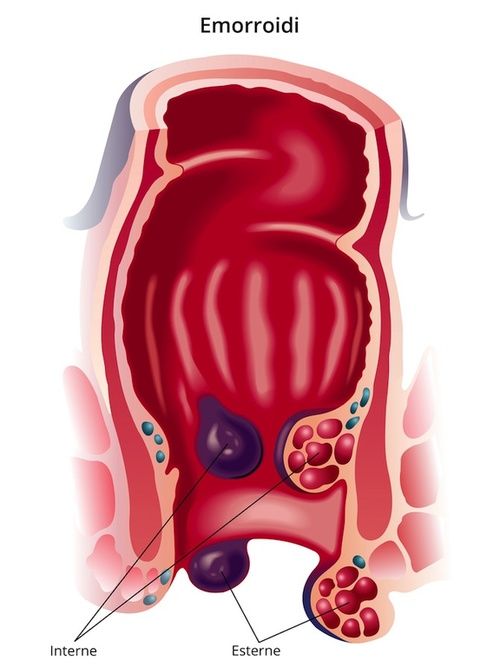 Sfiammare le emorroidi