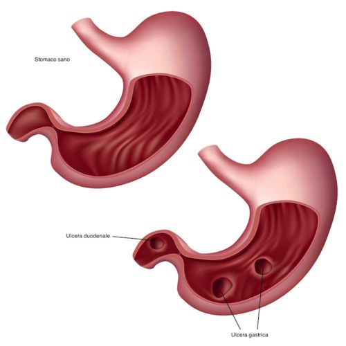 Ulcera gastrica, rimedi naturali