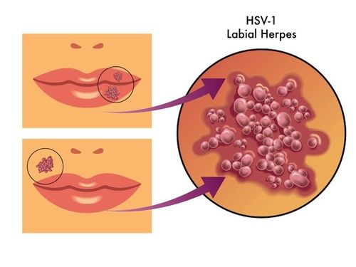 Herpes labiale, cure e rimedi naturali