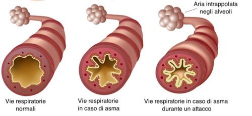 Asthma, natural remedies