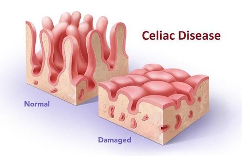 Celiachia: Sintomi, Cause, Tutti I Rimedi - Cure-Naturali.it