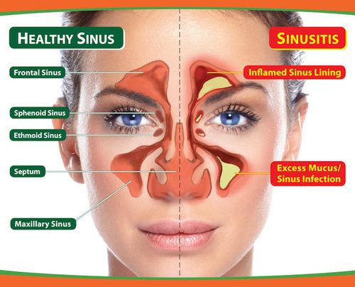 Sinusite: Sintomi, Cause, Tutti I Rimedi - Cure-Naturali.it