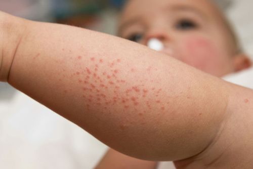 orticaria a chiazze