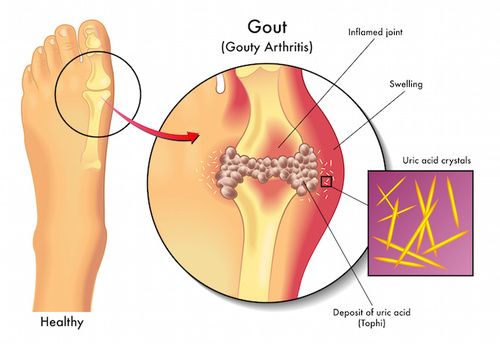 Tratamentul osteopatiei prostatitei