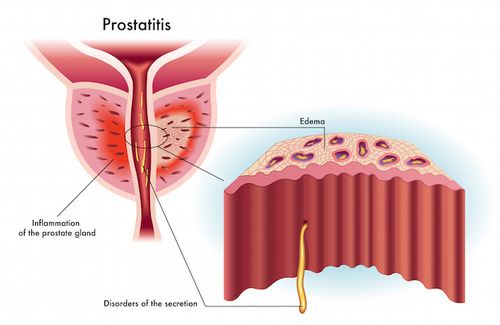 prostata congestionata