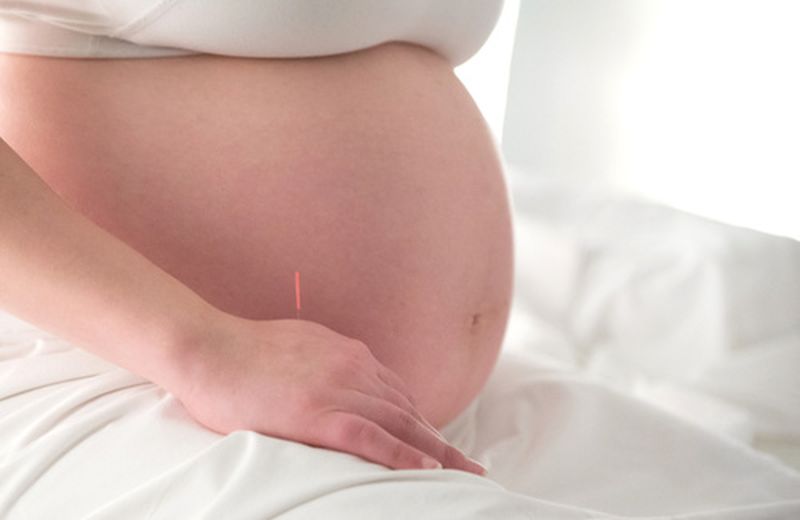 Agopuntura in gravidanza: l’apporto benefico dell’ago