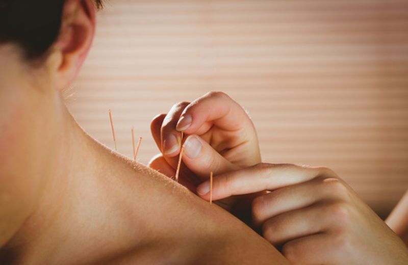 L'agopuntura per i dolori cervicali
