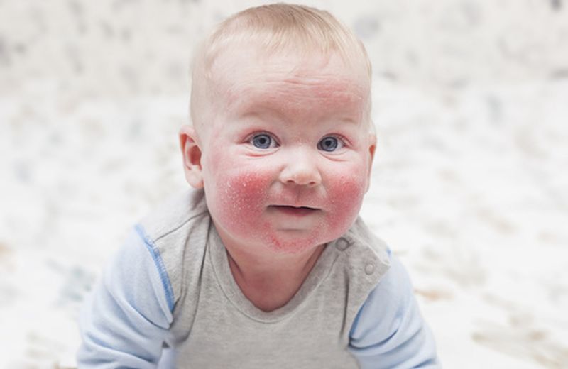 Dermatite seborroica al viso: creme e rimedi naturali