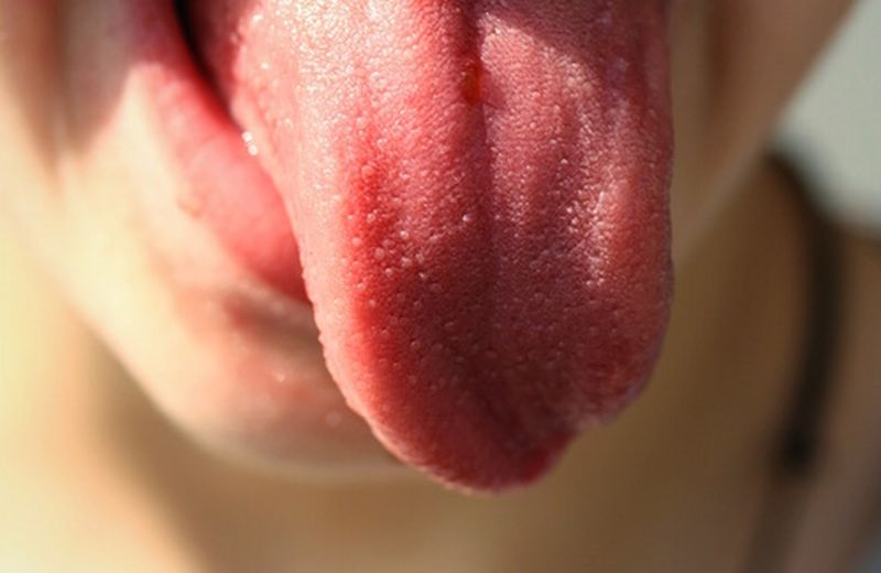 Candidosi orale: sintomi e rimedi naturali