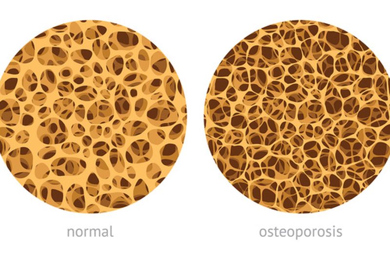 Osteoporosis: the "Stop fractures" campaign