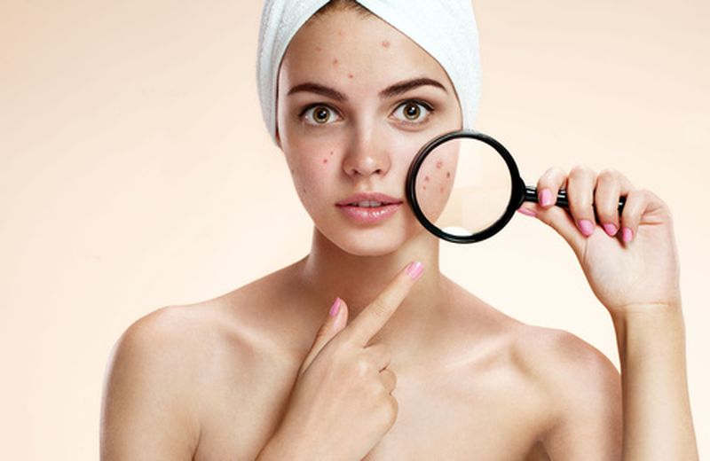 Acne tardiva, quanto dura?