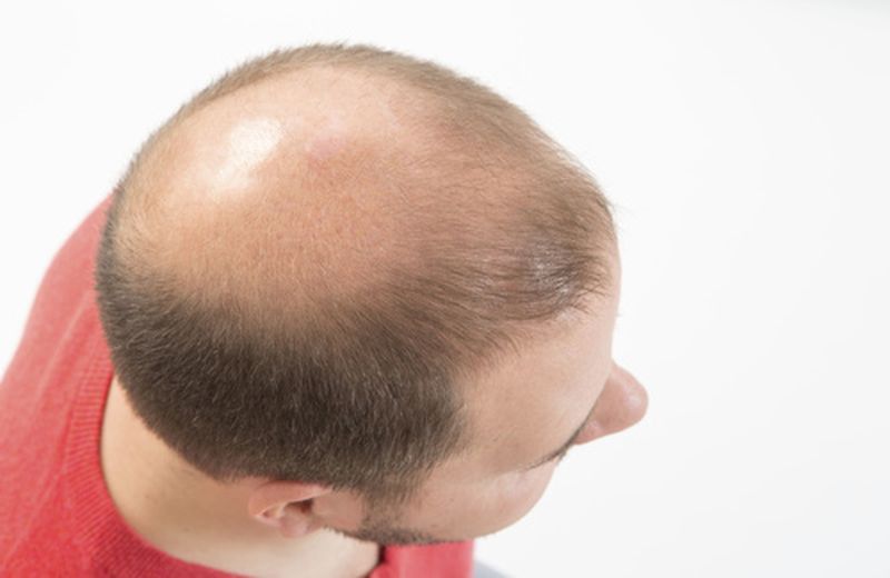 Alopecia areata, cause e rimedi - Cure-Naturali.it